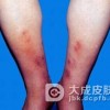 结节性红斑有哪些护理措施
