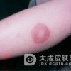 结节性红斑是传染性疾病吗