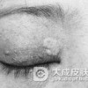 治疗黄瘤病的方法有什么