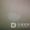 吃什么对白癜风好