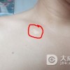刚出现白癜风是什么样的