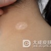 白癜风不及时治疗，危害究竟有多大