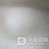 表皮囊肿患者饮食禁忌