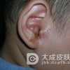 耳部湿疹的病因及其症状