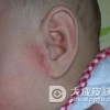 如何有效避免耳部湿疹的发生呢