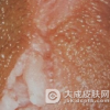 鉴别尖锐湿疣的方法有什么呢