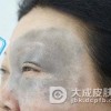 导致太田痣的病因有什么
