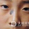 太田痣比较明显的特征是什么