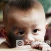 黑色太田痣会遗传吗