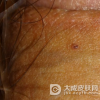 尖锐湿疣患者怎样才能正规治疗