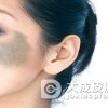 太田痣应怎么预防