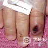 预防天花的办法有哪些