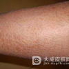 轻微鱼鳞病怎么护理呢