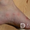 淤积性皮炎都有哪些发病特点