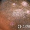 淤积性皮炎的症状都有哪些