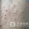 多发性脂肪瘤的特征