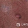 脂肪瘤有效的预防的方法