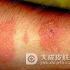 患有异位性皮炎要知道什么