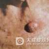 发疹型角化棘皮瘤的症状表现