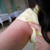 日光性荨麻疹的具体症状有哪些