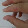 日光性荨麻疹的诊断和鉴别