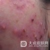 结节性痤疮如何治疗 告诉你多种治疗方法