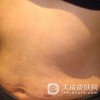 硬皮病容易与哪些病变混淆呢