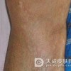 怎样有效的预防硬皮病的发生
