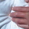 硬皮病到底吃什么好呢