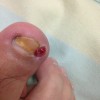 化脓性甲沟炎有些什么临床表现