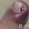 化脓性甲沟炎该如何预防？