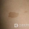 咖啡斑较佳治疗时期