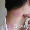 牛皮癣治疗中的注意事项