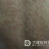 牛皮癣到底能否有效的治愈