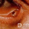 Kaposis肉瘤简介