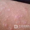 怎样护理日光性皮炎