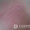 面部日光性皮炎的治疗方法