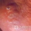阴囊湿疹的症状判断方法