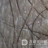 阴囊湿疹发作时会出现哪些症状