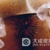 淋病患者怎么护理才专业