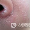 面部脂溢性皮炎的引发因素有哪些