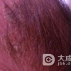 脂溢性皮炎后期症状是什么