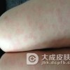 荨麻疹的分类是怎样的