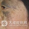 太田痣具有遗传性吗