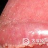 男性尖锐湿疣的发病部位有哪些