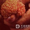男性尖锐湿疣存在哪些危害呢
