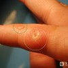 治疗瘊子的正常花费是多少？