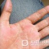 手癣怎么诊治