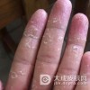 手癣的治疗注意什么