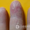 染上了手癣还能做菜吗